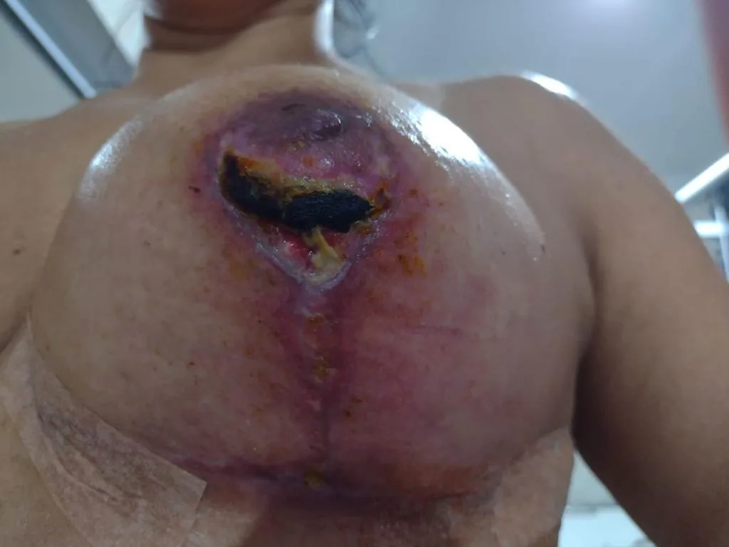 Detalhe da cicatriz de mama acompanhada com laser para cicatriz em Hortolândia/SP